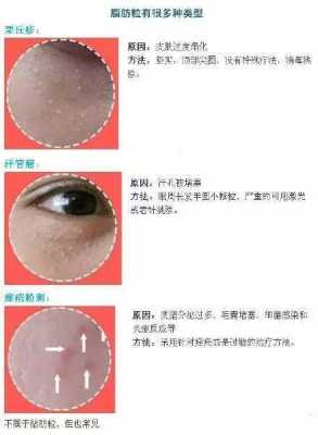 脂肪粒怎么形成的（为什么油脂粒会从毛孔里自己出来）