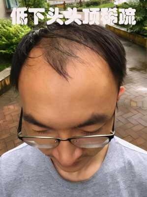 男生发际线高和什么有关,男人发际线高说明什么问题