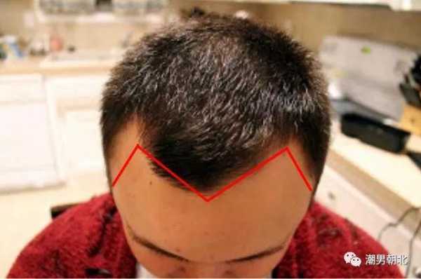 男生发际线高和什么有关,男人发际线高说明什么问题