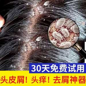 头皮屑太多了怎么办（头皮屑太多了怎么办用什么效果最好）