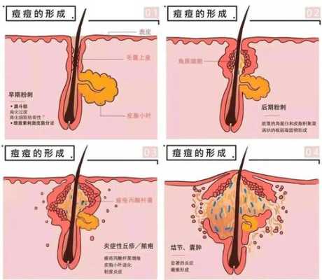女生下面长痘痘是什么原因（女生下面长痘痘是什么原因）