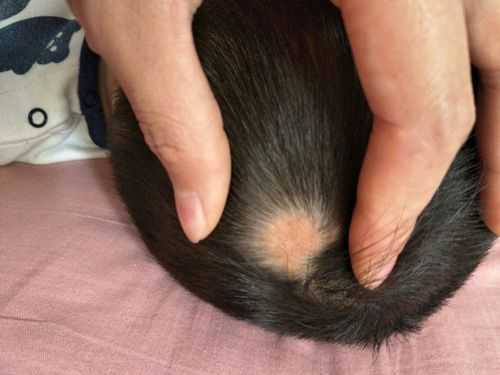 小孩头上有一块没头发还是白色的,头顶没有头发怎么办女的