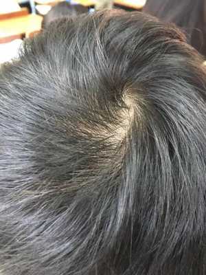 头发越来越少是什么原因,为什么头发越来越少又细软