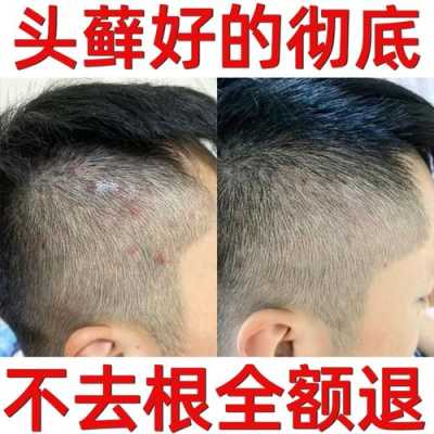 头皮发痒怎么办（头痒怎么治疗）