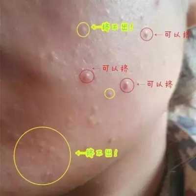 什么是闭口粉刺（什么是闭口粉刺图片）
