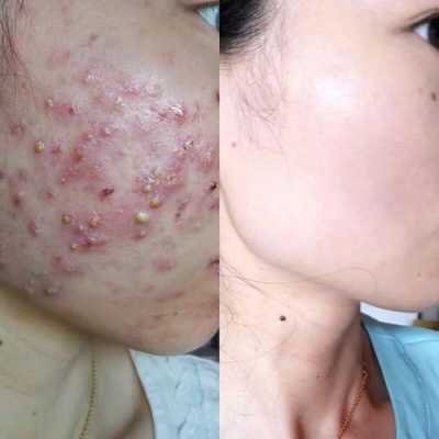 如何去除痘痘和痘印,怎么去痘痘和痘印最快最有效的方法
