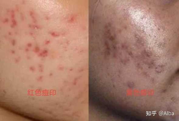 如何去除痘痘和痘印,怎么去痘痘和痘印最快最有效的方法