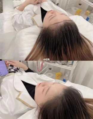 发际线后移怎么补救（发际线后移怎么解决）