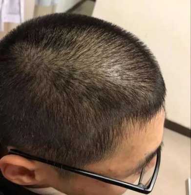 头发稀疏怎么变浓密（头发稀疏怎么变浓密男性）