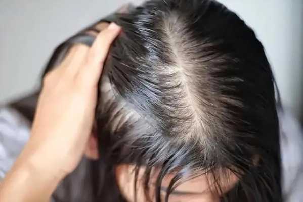 头发油是什么原因,长期头发油怎么回事