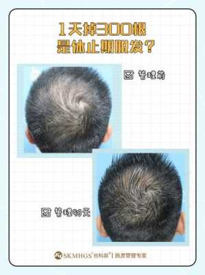 脱发、掉发都有哪些原因,经常脱发是什么原因造成的
