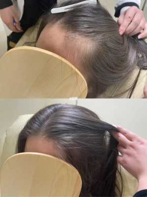 头发太少怎么办（头发太少怎么办?有方法可以增发吗）