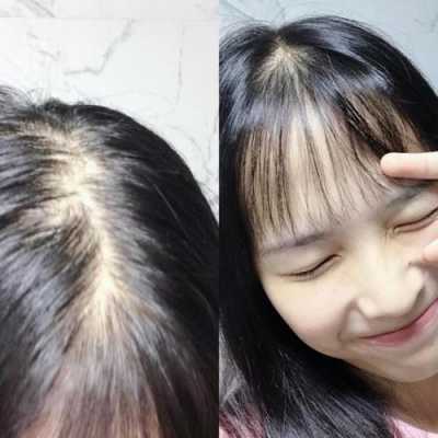 总掉头发怎么办,女生头发掉的多怎么办