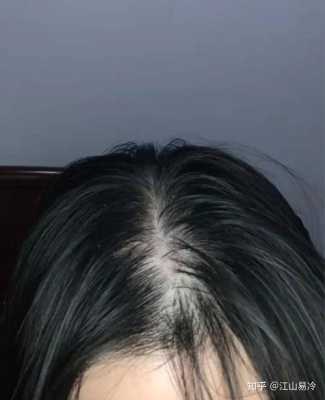 总掉头发怎么办,女生头发掉的多怎么办