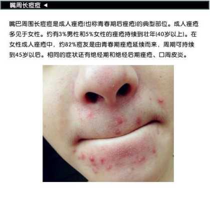 下巴长痘什么原因,下巴为什么长痘痘红肿硬硬的还疼