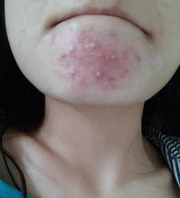 下巴长痘什么原因,下巴为什么长痘痘红肿硬硬的还疼