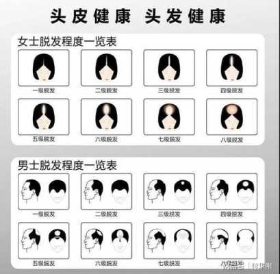 脱发严重是怎么回事,脱发严重是什么原因引起的