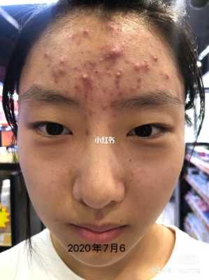 皮肤粉刺如何去除,粉刺怎么去除小妙招