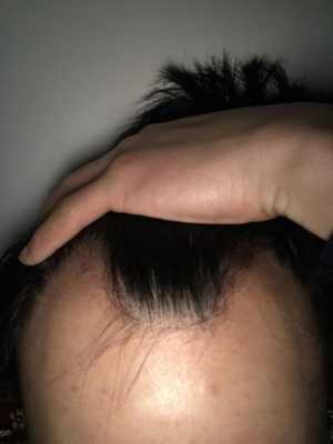 没有头发怎么办（没有头发怎么办）