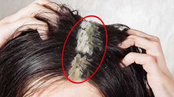 头上长虱子要怎么除去呢，最快速的办法,头皮怎么去除头皮屑