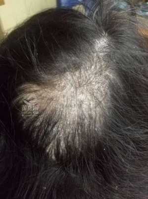 头皮屑特别多怎么办,头皮痒头皮屑多是什么病