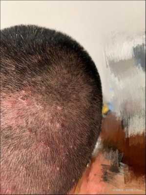 头顶长痘痘是什么原因（头顶长痘痘是什么原因怎么调理）