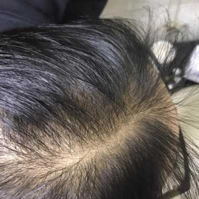 头发越来越少是什么原因（头发越来越少是什么原因造成的）