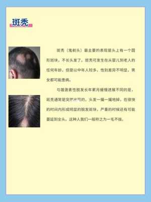什么是雄性激素脱发（什么是雄性激素脱发）