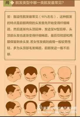 什么是雄性激素脱发（什么是雄性激素脱发）