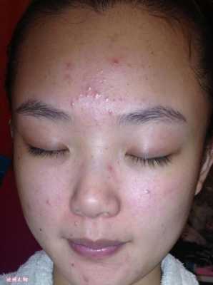 脸起疙瘩怎么办（脸起疙瘩怎么办用盐水洗可以吗）