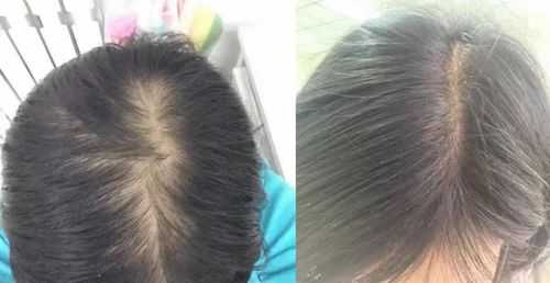 脱头发怎么办（女孩子脱头发怎么办）