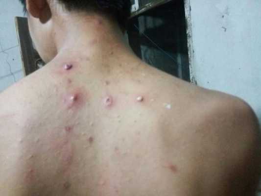 后背一直有痘痘,是什么原因,要怎样才能消除呢,初中男生背上长痘怎么办