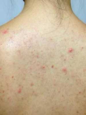 后背一直有痘痘,是什么原因,要怎样才能消除呢,初中男生背上长痘怎么办