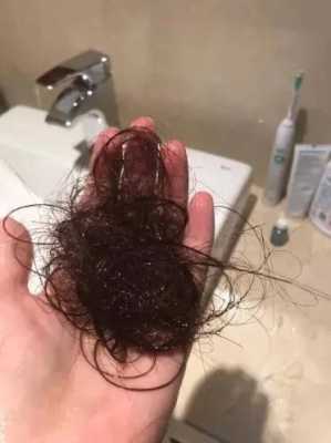 掉头发多怎么办（女生掉头发多怎么办）