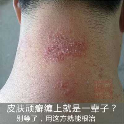头屑多头皮痒怎么治,头皮痒怎么治疗用什么药好