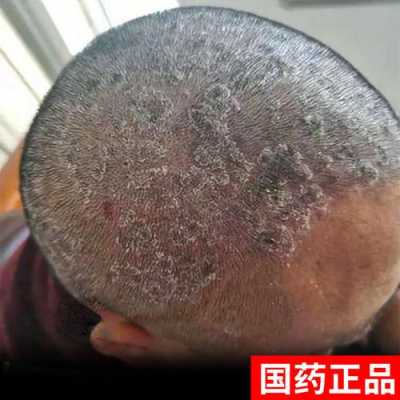 头屑多头皮痒怎么治,头皮痒怎么治疗用什么药好