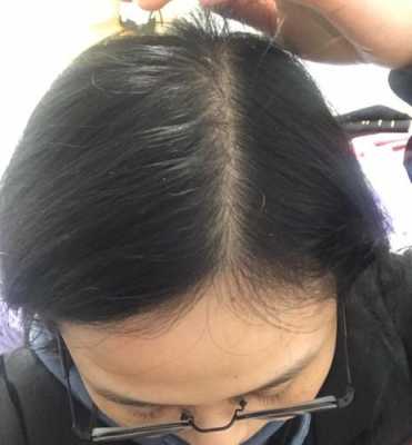 为什么发尾头发特别少,体毛重头发少为什么