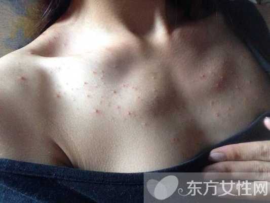 下面长痘痘怎么办（下面长痘痘怎么办挤出有白色的）