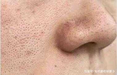 为什么毛孔粗大（为什么毛孔粗大怎么改善）