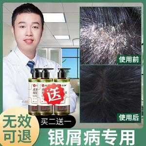 头发用什么洗好,头部银屑病用什么洗头发好