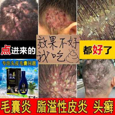 头发用什么洗好,头部银屑病用什么洗头发好
