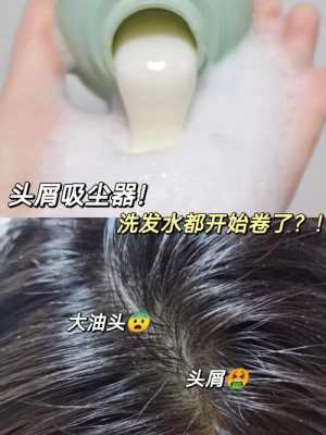 头上的头皮屑如何清理干净,冬天头发头皮屑多怎么办