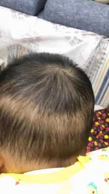 头发少怎么变多（我小孩今年1岁半了，怎么头发特别稀少，特别是头顶上面，怎么办）