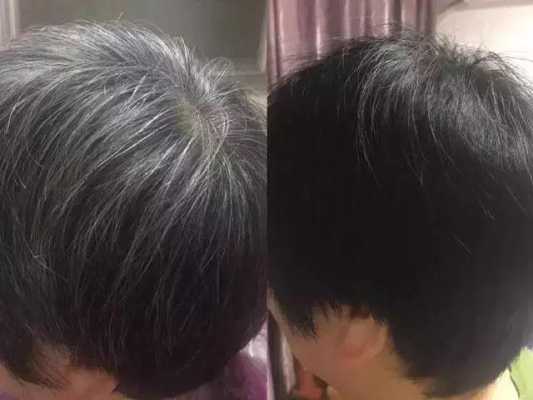 怎么改善白头发（白头发怎么改善效果最好）