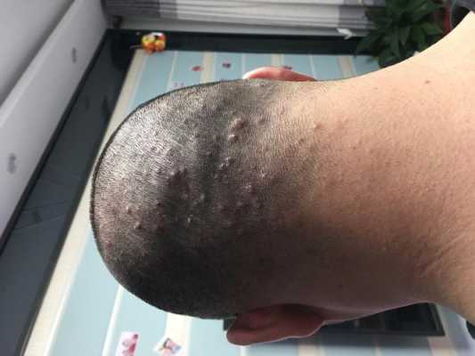 头上起痘痘怎么回事（头上起痘痘怎么回事儿）