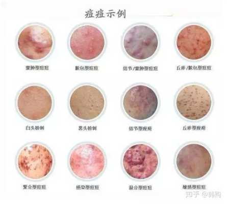 长痤疮是什么原因（长痤疮是什么原因引起的）
