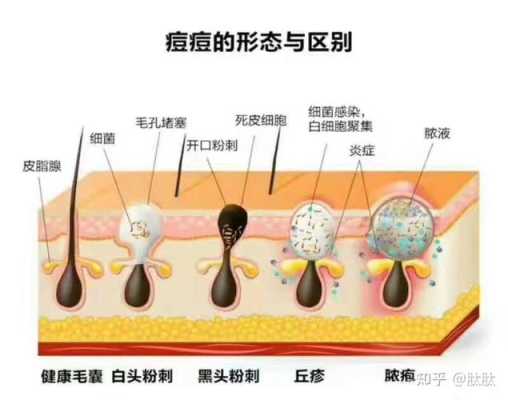长痤疮是什么原因（长痤疮是什么原因引起的）