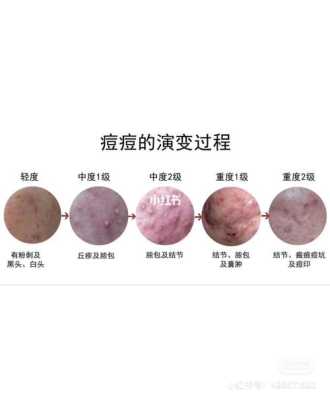 长痤疮是什么原因（长痤疮是什么原因引起的）