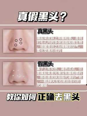 鼻头有黑头怎么办（鼻头有黑头怎么办,用盐）