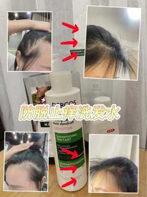 用什么可以长头发（用什么可以长头发和预防脱头发）